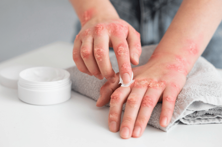 Psoriasis & eczema