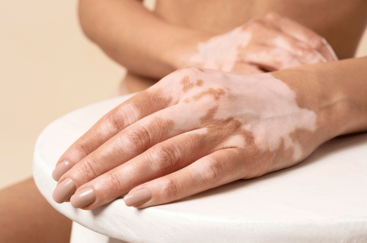 Vitiligo Treatment